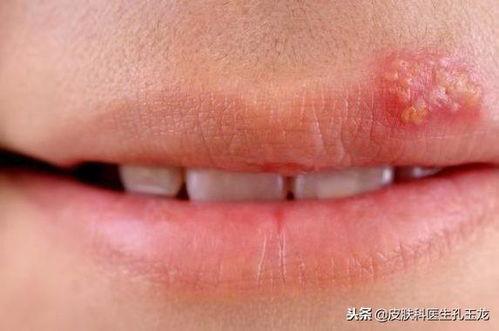 明星疱疹,揭秘明星疱疹背后的真相